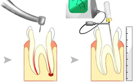 显微根管治疗技术