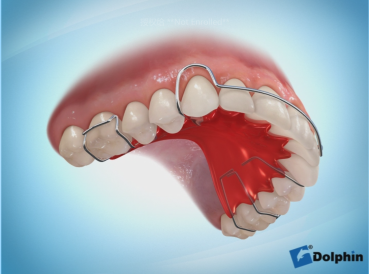 下颌舌弓保持器图片图片