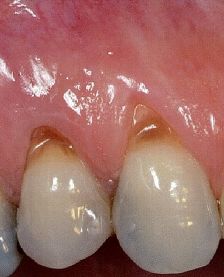 毛牙刷或长期大力横到刷牙常常导致牙龈退缩,同时还会造成牙齿损伤