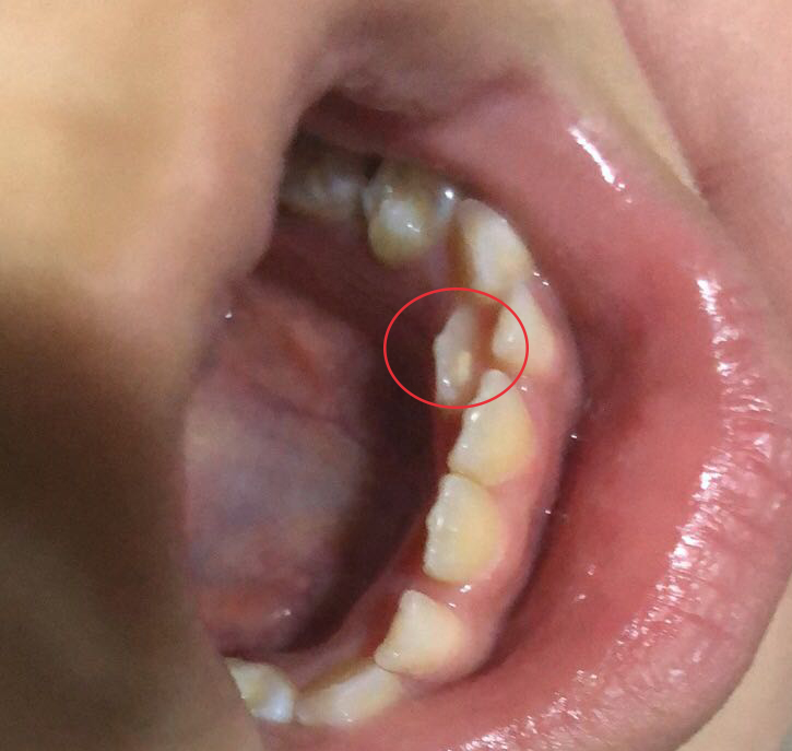 汕头口腔医疗中心儿童齿科医生表示,滞留乳牙拔除后,错位恒牙是否能